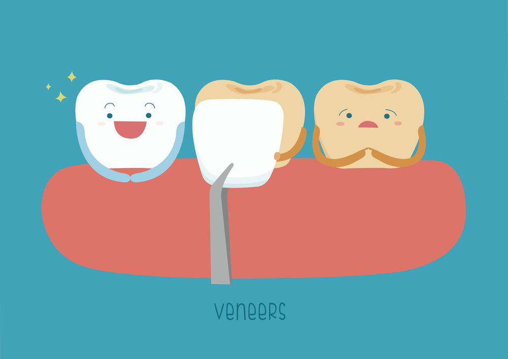 veneers and teeth illustration